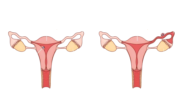 Ectopic Pregnancy