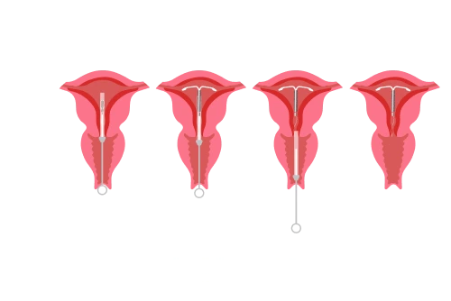 Intrauterine Device