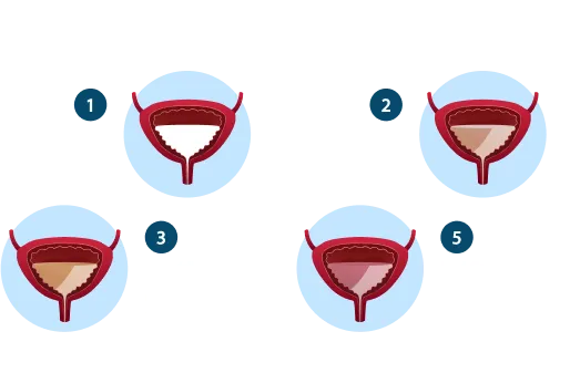 Urinary Tract Infection