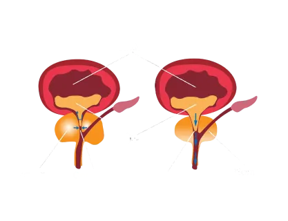 Prostatitis