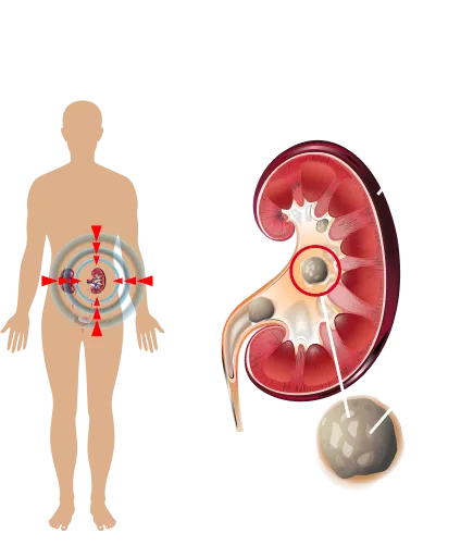 Kidney Stones