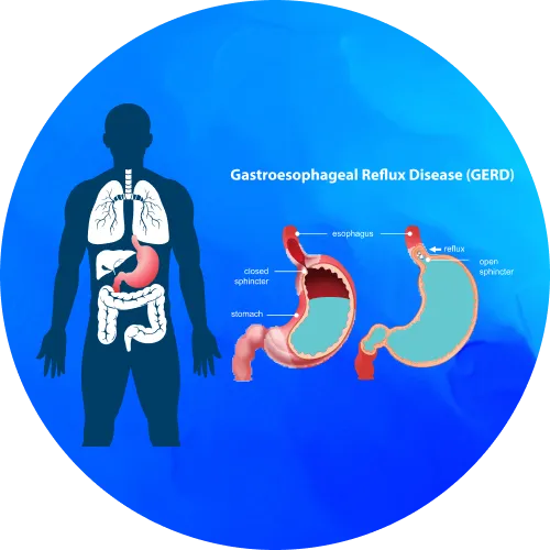 Acute peptic disease - lifeplus