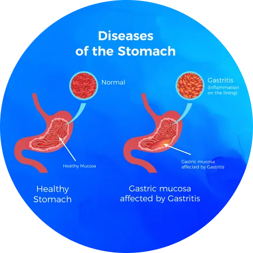 Acute peptic disease - lifeplus