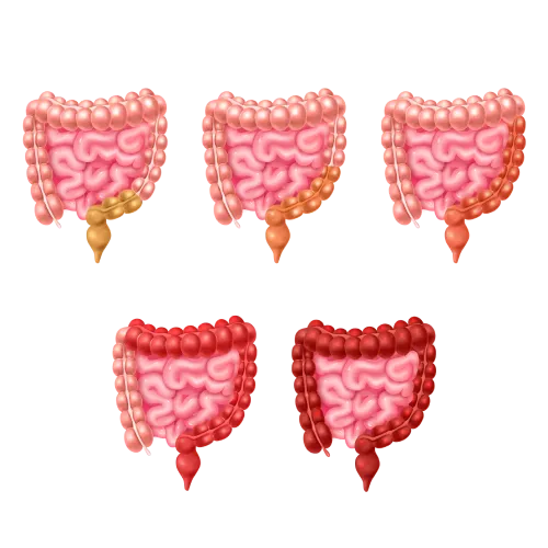 Colitis