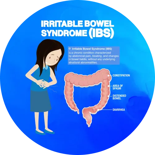 irritable bowel syndrome