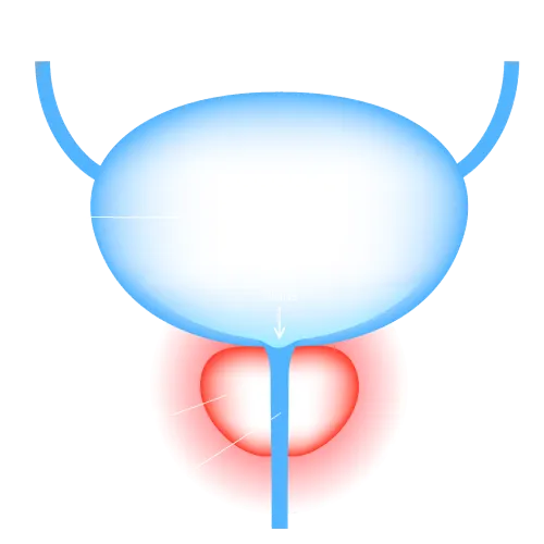 Prostatitis