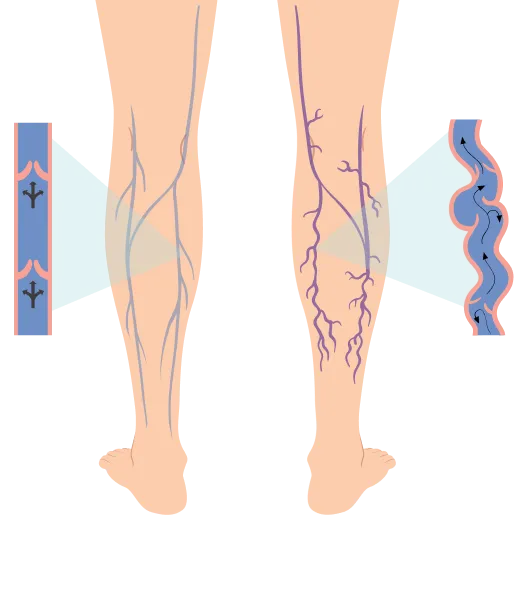 Varicose veins