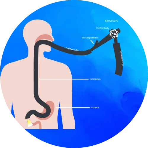 Endoscopy - lifeplus