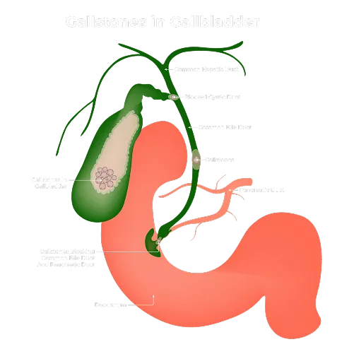 Gallstones