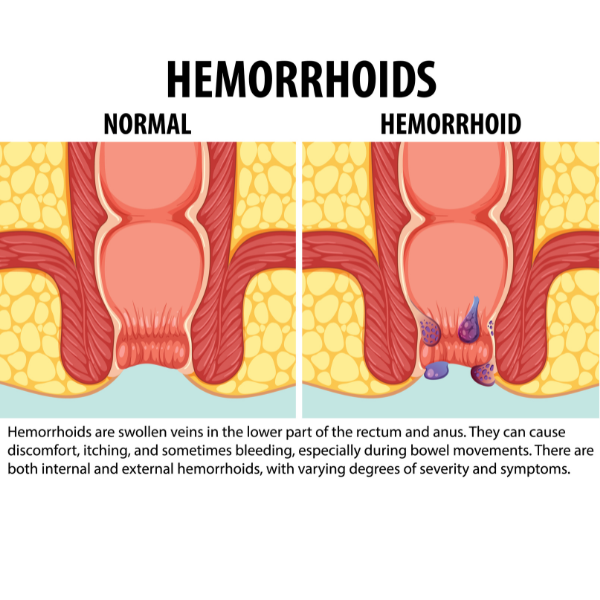 Haemorrhoids