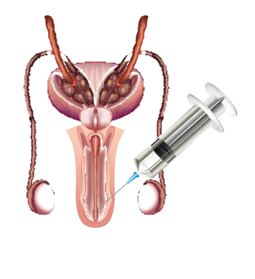 Erectile Dysfunction